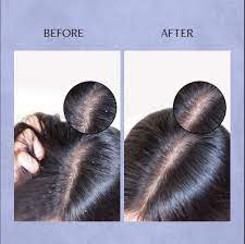 Hairfall Treatment
