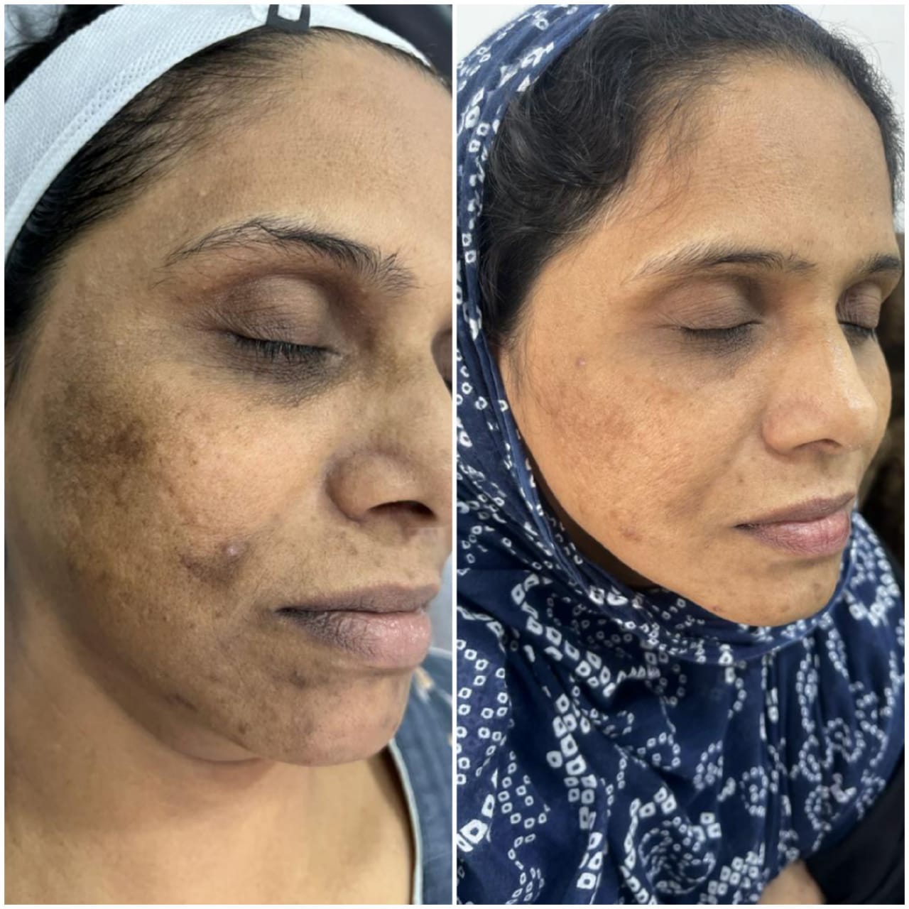 Pigmentation Treatment