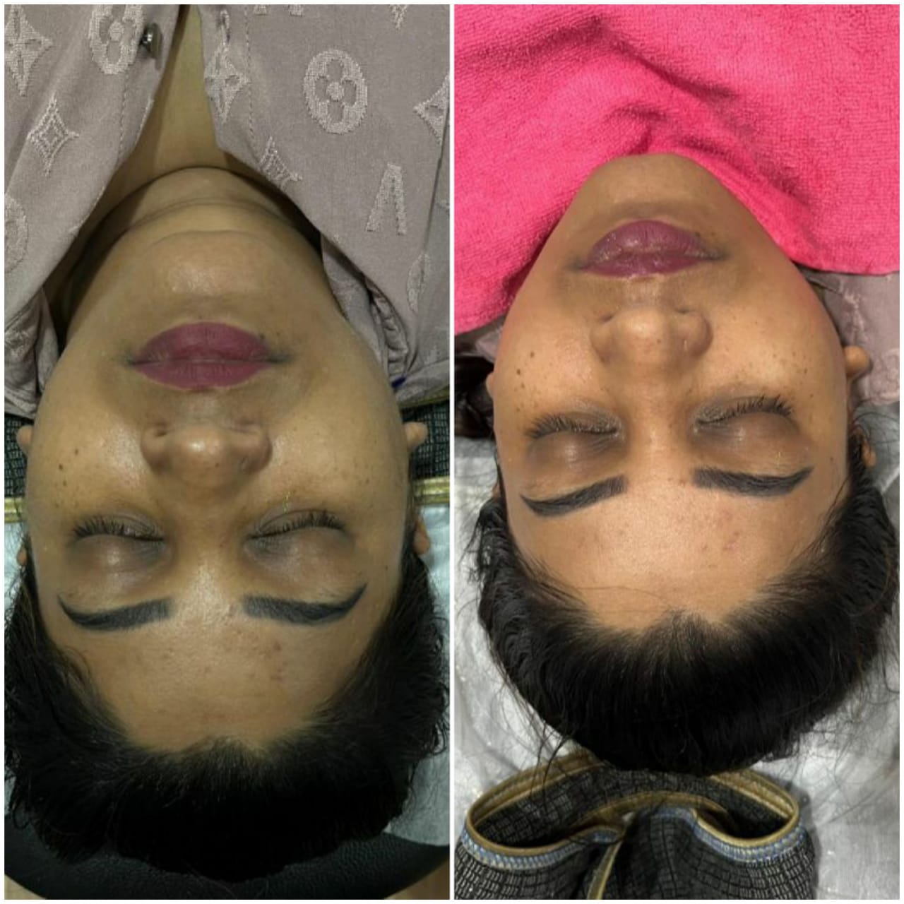 Laser Skin Surfacing